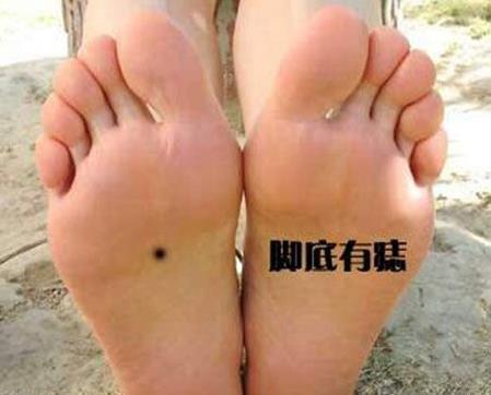 脚底板有痣的女人好吗