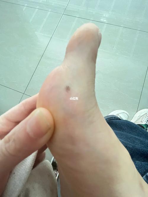 脚边边有痣代表什么意思