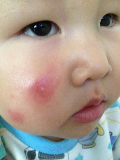 梦见脸被虫子咬了是什么征兆?