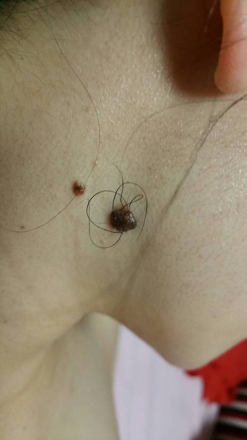 痣上长毛能点吗