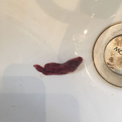 见月经掉下来血块预示着什么