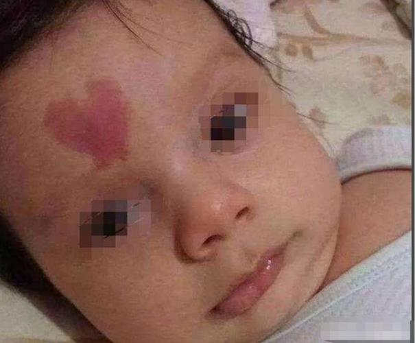 额头胎记的人一生命运如何?