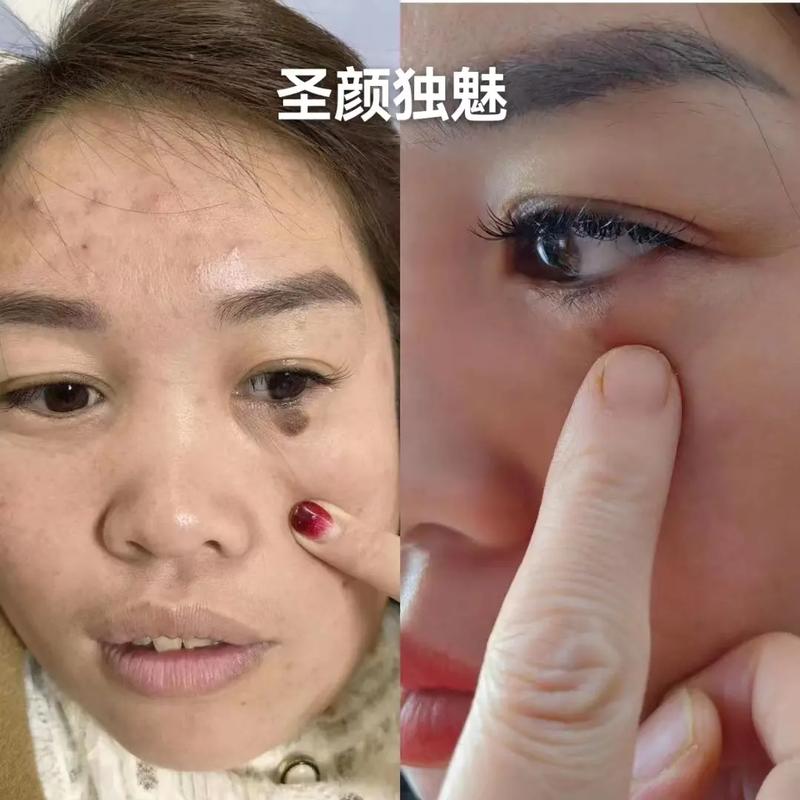 九夫痣是什么意思