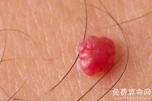 身体的痣呈红色好吗