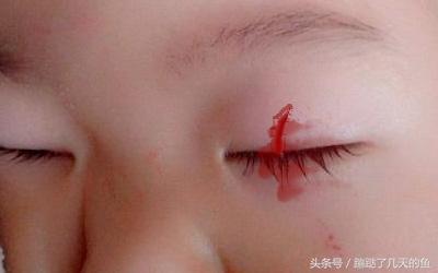梦见孩子一只眼睛受伤,梦见眼睛受伤预示着什么