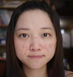 梦见脸上长痘 周公解梦之梦到脸上长痘
