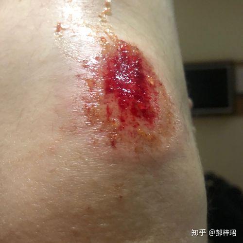 做梦梦到膝盖受伤不流血预示着什么意思