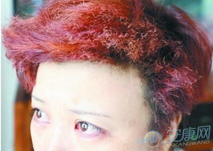 梦见头发被烧了是什么意思