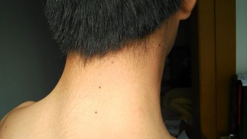 脖子上有三颗痣连成一条线