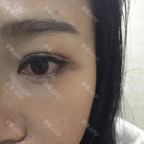 卧蚕眼下面有皱纹好吗