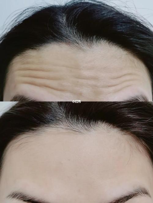 抬头纹和斩子纹重合好吗
