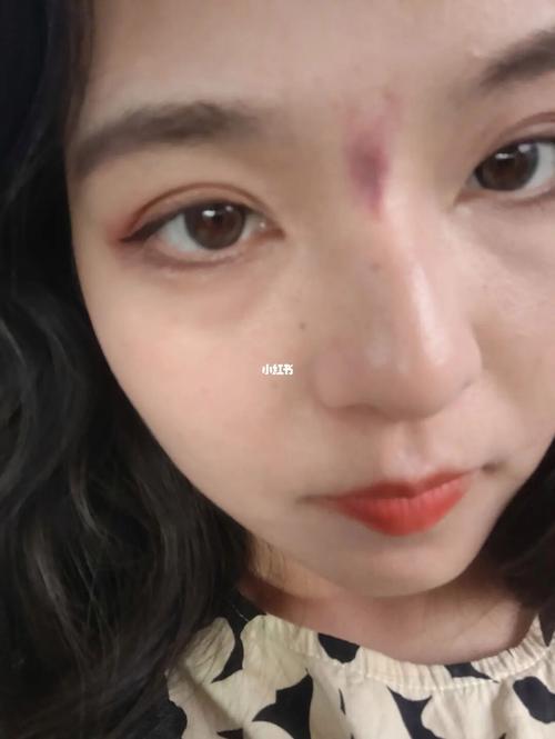 额头破相有什么化解的方法