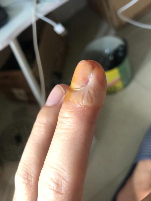 梦见被螃蟹咬 梦见被螃蟹咬手是什么意思