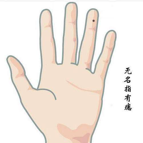 无名指有痣还是恶痣运势如何