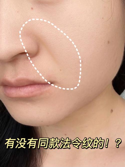 法令纹长好吗 有什么影响