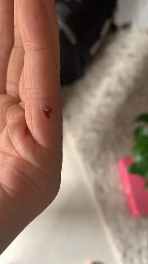 梦见被猫咬伤手指头