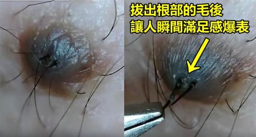 痣上长毛能拔吗