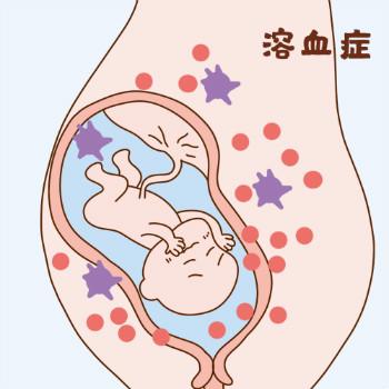 溶血症孕妇有什么反应