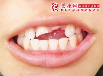 梦见牙断了牙根还在什么意思