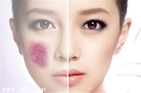 胎记长在脸上代表什么命运