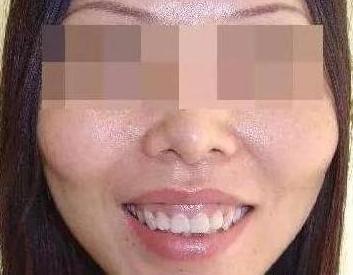 牙齿前凸的女人克夫