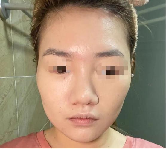 面相太阳凹陷的女生