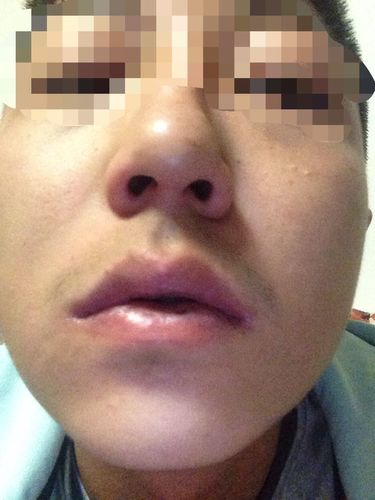 鼻梁歪鼻孔一大一小