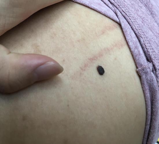 后背有痦子是什么意思?