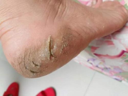 梦见脚后跟裂开有什么征兆