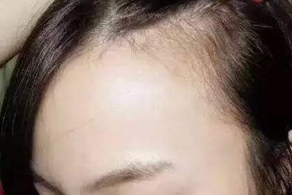 发际线低与命运