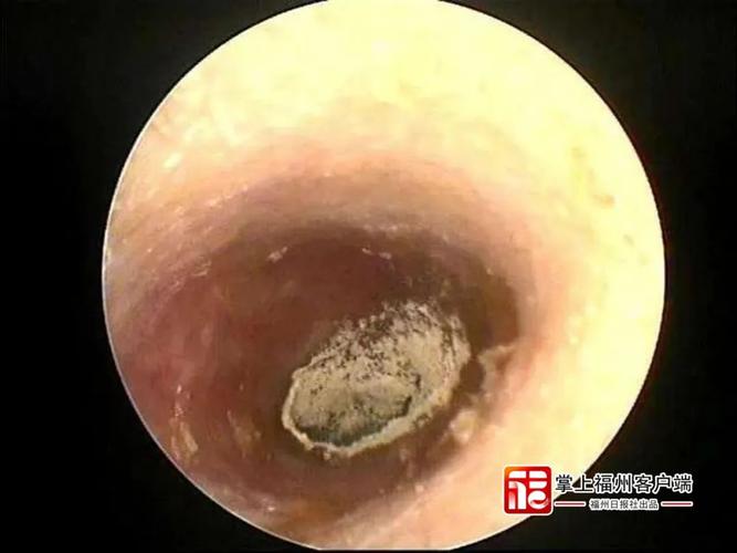 梦见耳朵里长毛的人怎么回事