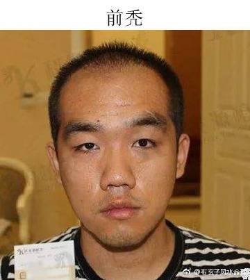 秃头额的男人一生运势如何