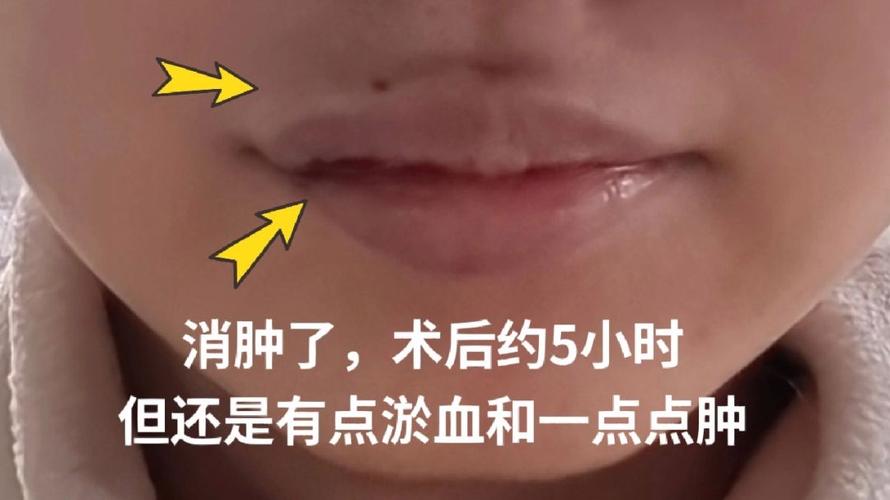 嘴唇有疤的人命运如何