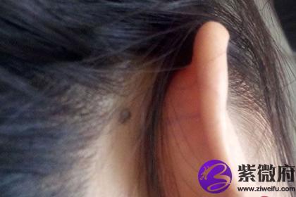 耳后有恶痣身后有小人
