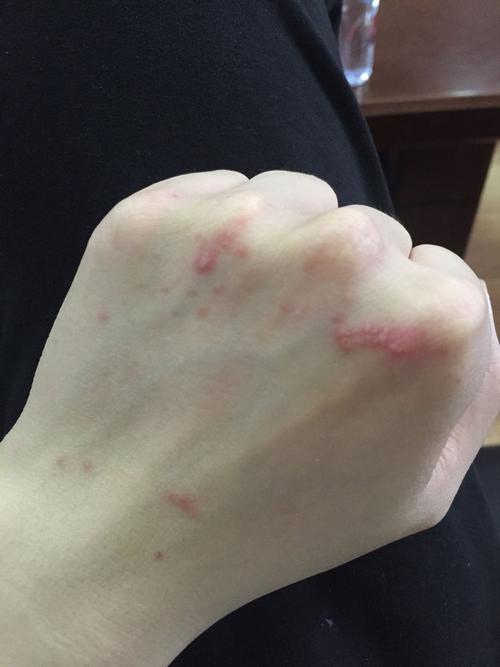 梦见虫子咬手 梦见虫子咬手见血好不好