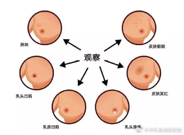 乳房上的胎记代表什么含义?