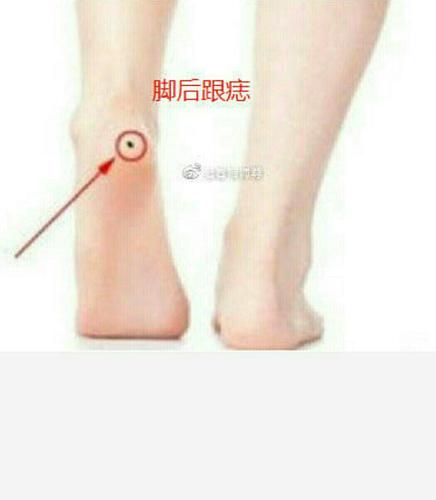 女人脚后跟长痣好不好