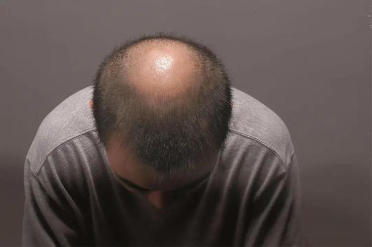 年纪轻轻头发稀疏的男人运势好吗