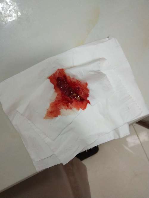 梦见自己咳出血
