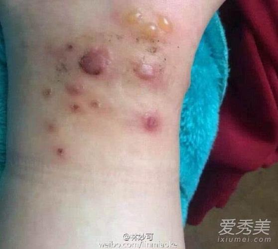 梦见毒虫咬进皮肤里