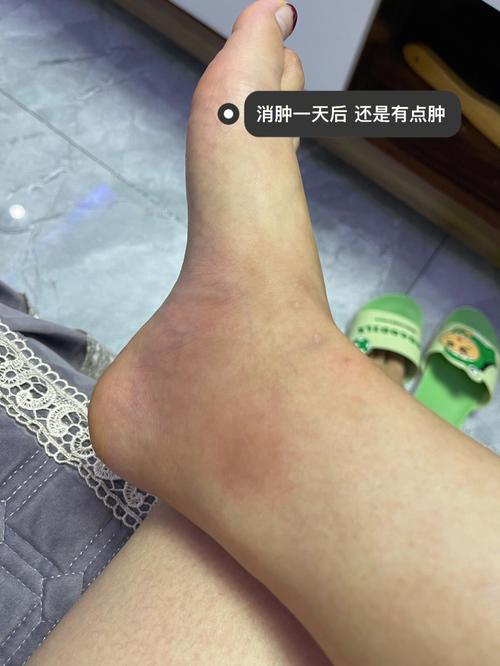 梦见马蜂蛰了自己的腿