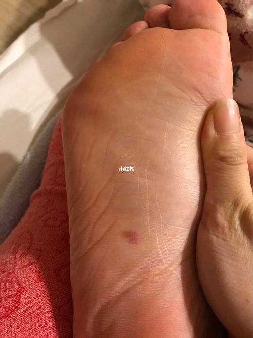 脚上有红胎记的老说法