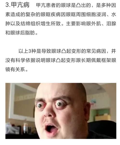 眼球外凸的人是不是经常在言而无信