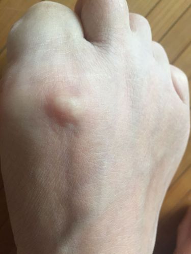 梦见自己肚子里长了瘤子