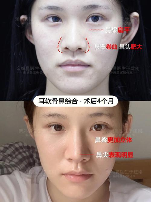 山根有疤女人有什么化解方法
