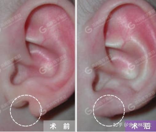 耳朵天生缺一小块是为啥