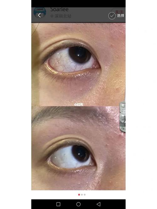 眼带血丝面相到底是好还是坏