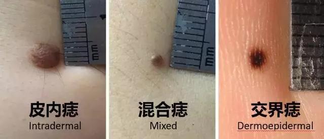 可能会影响身体健康的痣有哪些