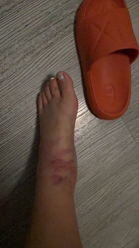 梦见别人的脚肿