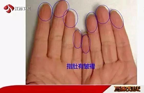 手指肚上有竖纹图解